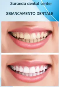 Teeth whitening before-and-after illustration used by Saranda Dental Center